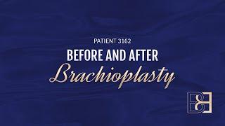 Brachioplasty (Arm Lift) Post Weight Loss {Patient 3162} Before & After