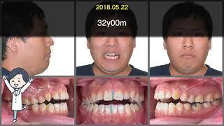 Case Analysis：Anterior Open Bite｜【Chris Chang Ortho】CC603