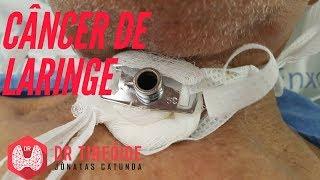 Câncer de laringe - Sintomas, diagnóstico e tratamento! | Dr Jônatas Catunda