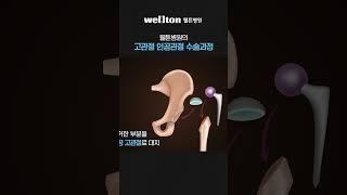 30초만에 알아보는 웰튼병원의 고관절 인공관절 수술과정(고관절 전치환술) #고관절수술