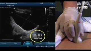 Hot Tip - Measuring Bladder Volume with Ultrasound