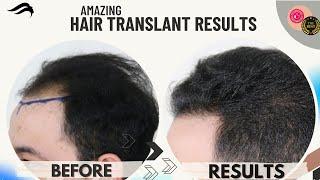 Hair Transplant In Tirupati | Best Cost Results Doctor & Center Of Hair Transplant In Tirupati