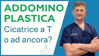 Addominoplastica con Cicatrice a T invertita o ad ancora ? - Dr Arnaldo Paganelli Chirurgo Plastico