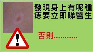 [痣 ]發現這種痣要立刻看醫生,分分鐘救你一命!Be careful if you have a mole with white rim!(中文/EngSub)