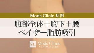 腹部全体+胸下＋腰 ベイザー脂肪吸引【モッズクリニック症例】