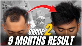 Best Hair Transplant Result 2022 | Grade 2 | Hairline Recreate | QHT Clinic Haridwar