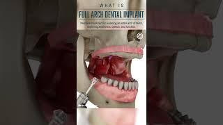 What is a Full Arch Dental Implant #shorts #dental #implant #animation #science #medical