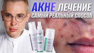 АКНЕ ЛЕЧЕНИЕ | самый реальный способ вылечить #акне НАВСЕГДА #роаккутан