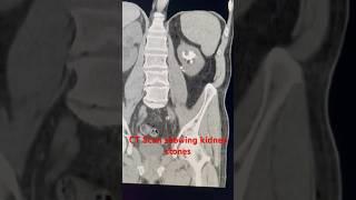 CT scan showing kidney stones #kidneystones #kidneystone #urology