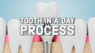 Tooth in a Day