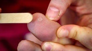 The Best Method for Removing Warts | Earth Science