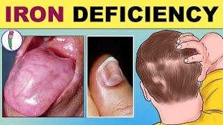 Iron Deficiency Anemia - Signs & Symptoms | Iron Deficiency - Early & Late Signs