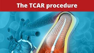 The TCAR procedure