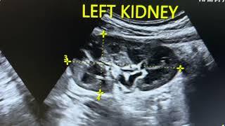 14 yr girl 4Hb . 2-3 days diarrhoea. Just for record keeping.