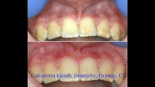 Laser Labial Frenectomy Procedure | Calcaterra Family Dentistry, Orange CT