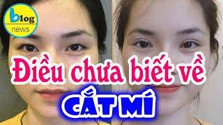 Phẫu Thuật Cắt Mí Mắt và Những Điều Bạn Nên Biết