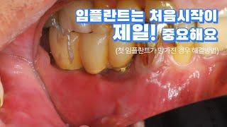 [대전치과, 대전 임플란트] 임플란트는 처음 시작이 제일 중요해요 (첫 임플란트가 망가진 경우 해결 방법)