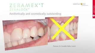 Zirconium Dental Implant introduction ZERAMEX® T