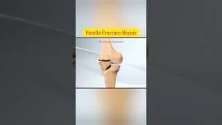 Patella Fracture Repair ll Animation ll @SG Pharma Dictionary