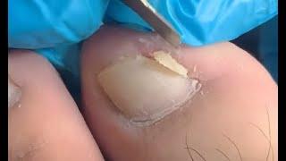 How to repair toenails
