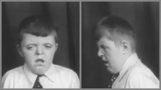 Hypertelorism and Oxycephaly. 1950s medical documentary on "Feebleminded"
