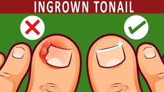 How to Get rid of Ingrown Toenail Naturally | 10 Home Remedies