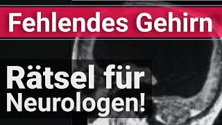 UNERKLÄRLICHE Anomalie?  Hirnverletzungen, die Neurologen verblüffen. (WMiB13)