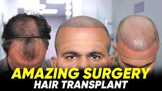 Hair Transplant in Navsari | Best Results & Cost of Hair Transplant in Navsari