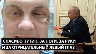 Спасибо Путин! За сломанные руки, ноги и за отрицательный левый глаз