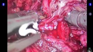 Left prostate pedicle, sparing ofneuro-vascular bundle