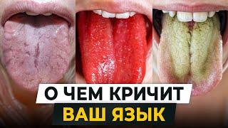 О каких БОЛЕЗНЯХ кричит ВАШ ЯЗЫК? / Как проверить свое здоровье по языку?