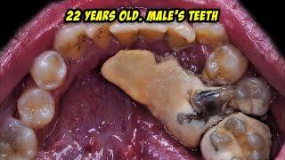 One Of The Biggest Tartar I've Ever Faced | Scaling | Dentist | Dokter Gigi Tri Putra