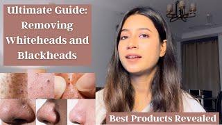 Say Goodbye to Whiteheads and Blackheads | Product Recommendations #skincare