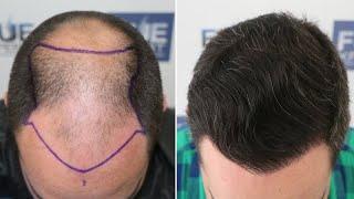 FUE Hair Transplant (4766 Grafts NW V) By Dr Juan Couto - FUEXPERT CLINIC, Madrid, Spain