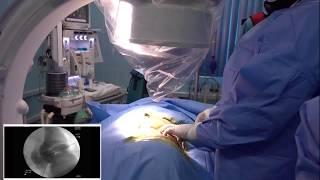 Percutaneous Nephrolithotomy (PCNL) Walkthrough (With Subtitles)