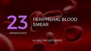 Part 1 - Preparation of Peripheral Blood Smear (PBS)