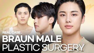 MALE PLASTIC SURGERY BEFORE AND AFTER : BRAUN PLASTIC SURGERY IN KOREA