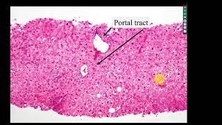 Top challenges in Hepatic Pathology