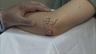 Elbow Joint Injection