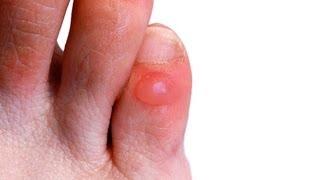 How to Prevent & Treat Foot Blisters | Foot Care