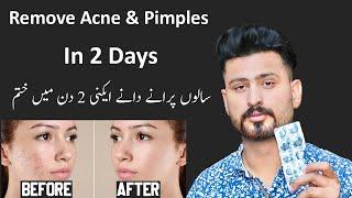 Best Treatment For Remove Pimple & Acne In 2 Days | Pimples Removal Permanent On Face at Home