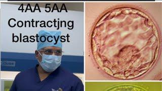 Ivf ICSI#blastocyst 4AA expanded blast 5AA hatching blastocyst poor blastocyst embryo biopsy#ivf