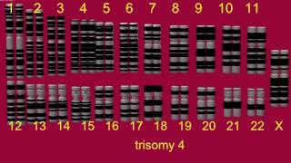 TRISOMY, DOUBLE TRISOMY, TETRASOMY