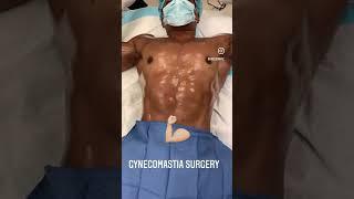 GYNECOMASTIA SURGERY & BEYOND #transformation #beforeandafter #plasticsurgeon #local