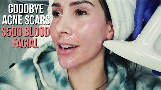 GETTING A $500 PRP FACIAL + Workout At House Concepts