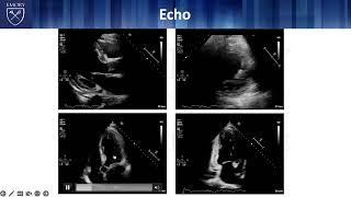 The Late-Presenting STEMI: A Tale of Two STEMIs and the Importance of Time