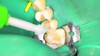 Cementation of a Glass Ceramic Inlay with RelyX™ Ultimate Adhesive Resin Cement