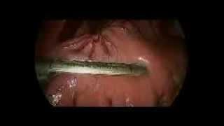 Laparoscopic Gastric Sleeve by Dr Craig Taylor OClinic Sydney