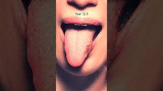 Tongue Cancer Time Lapse