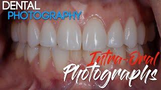 Dental Photography Basics - Dental Photography Techniques - Intra-oral Photographs